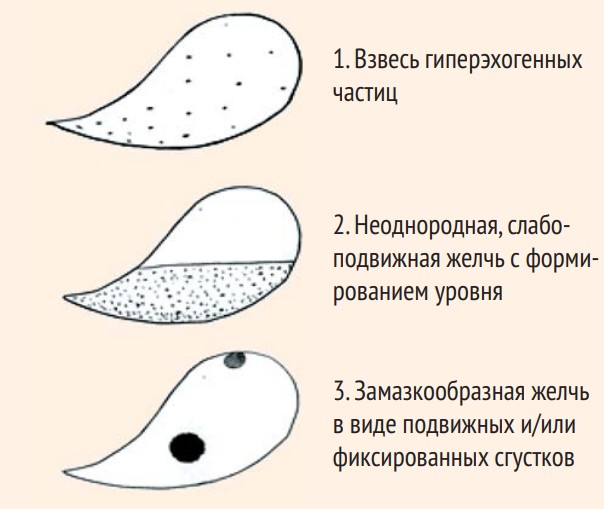  Билиарный сладж: решенные и нерешенные вопросы рисунок 1 | Гастроканон